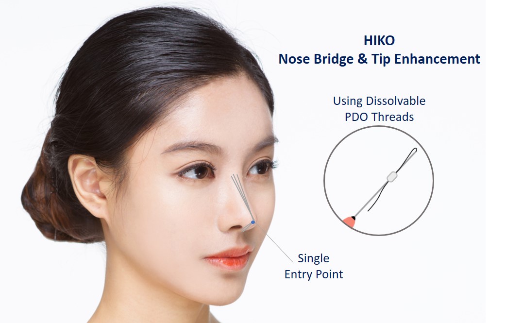 hiko nose threadlift