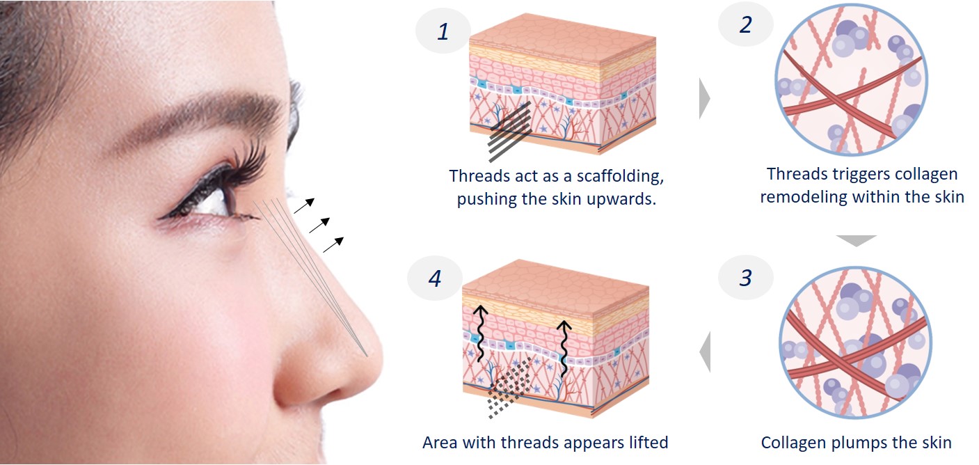 hiko nose threadlift process