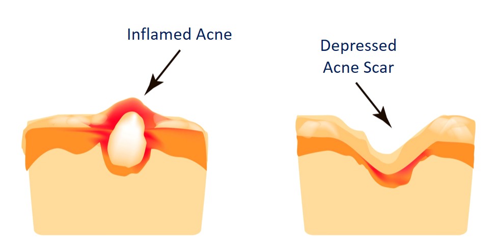 how acne scars form on skin