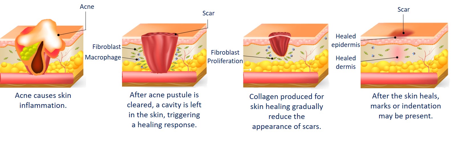 how acne scars form