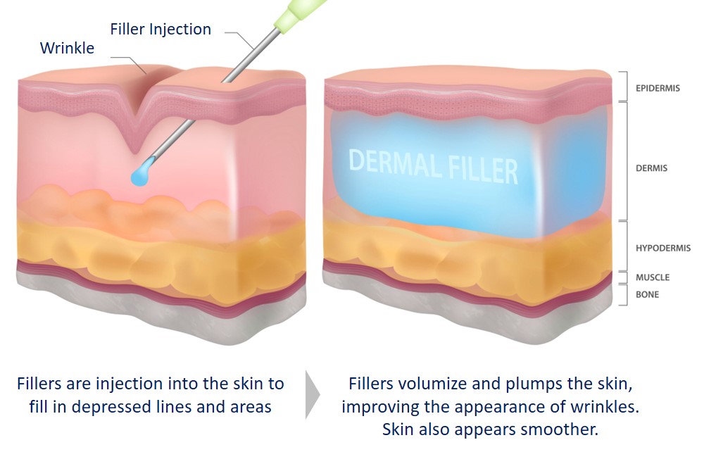 how dermal fillers help improve wrinkles and line