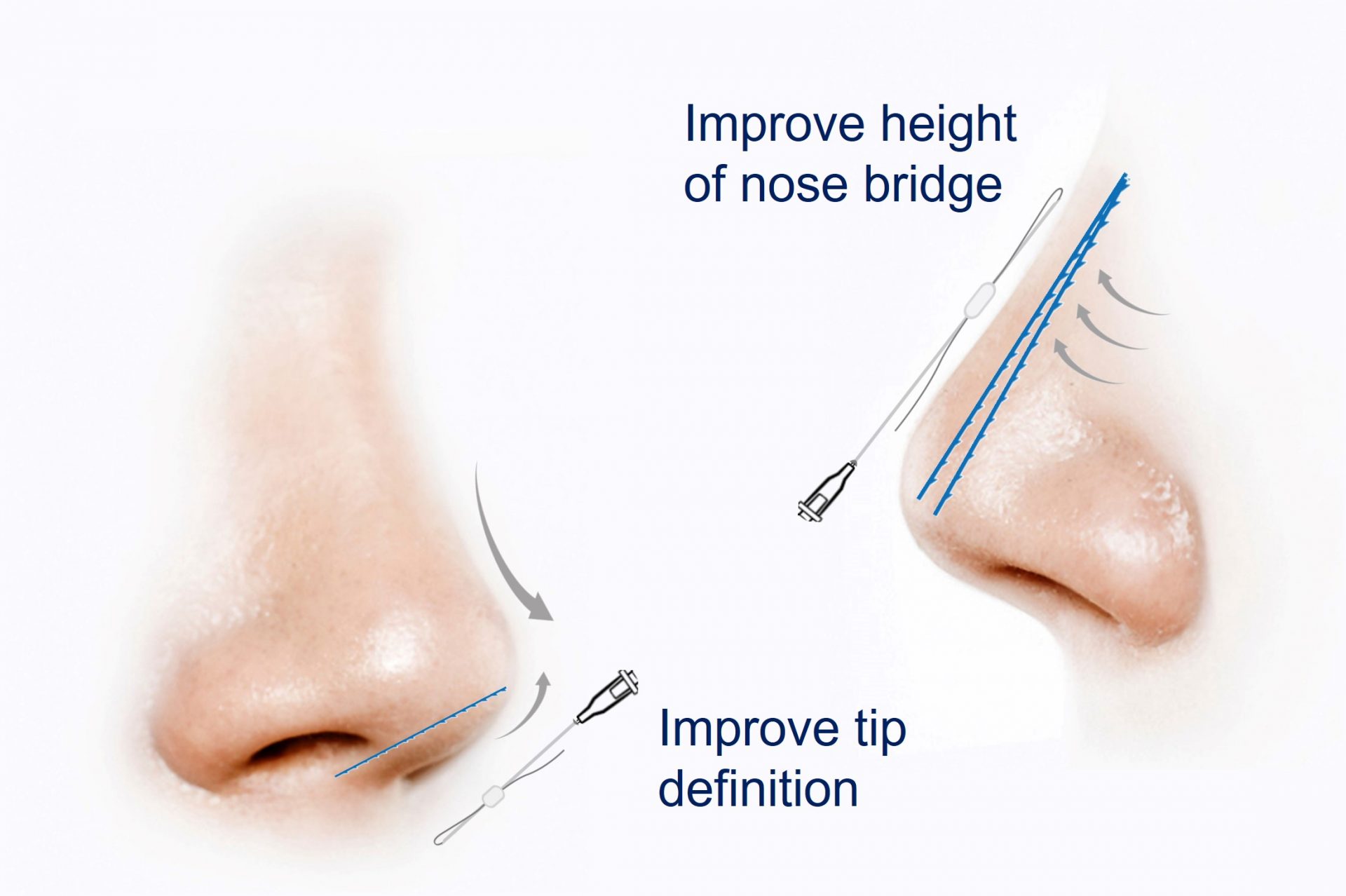 how does hiko help to enhance nose bridge and tip