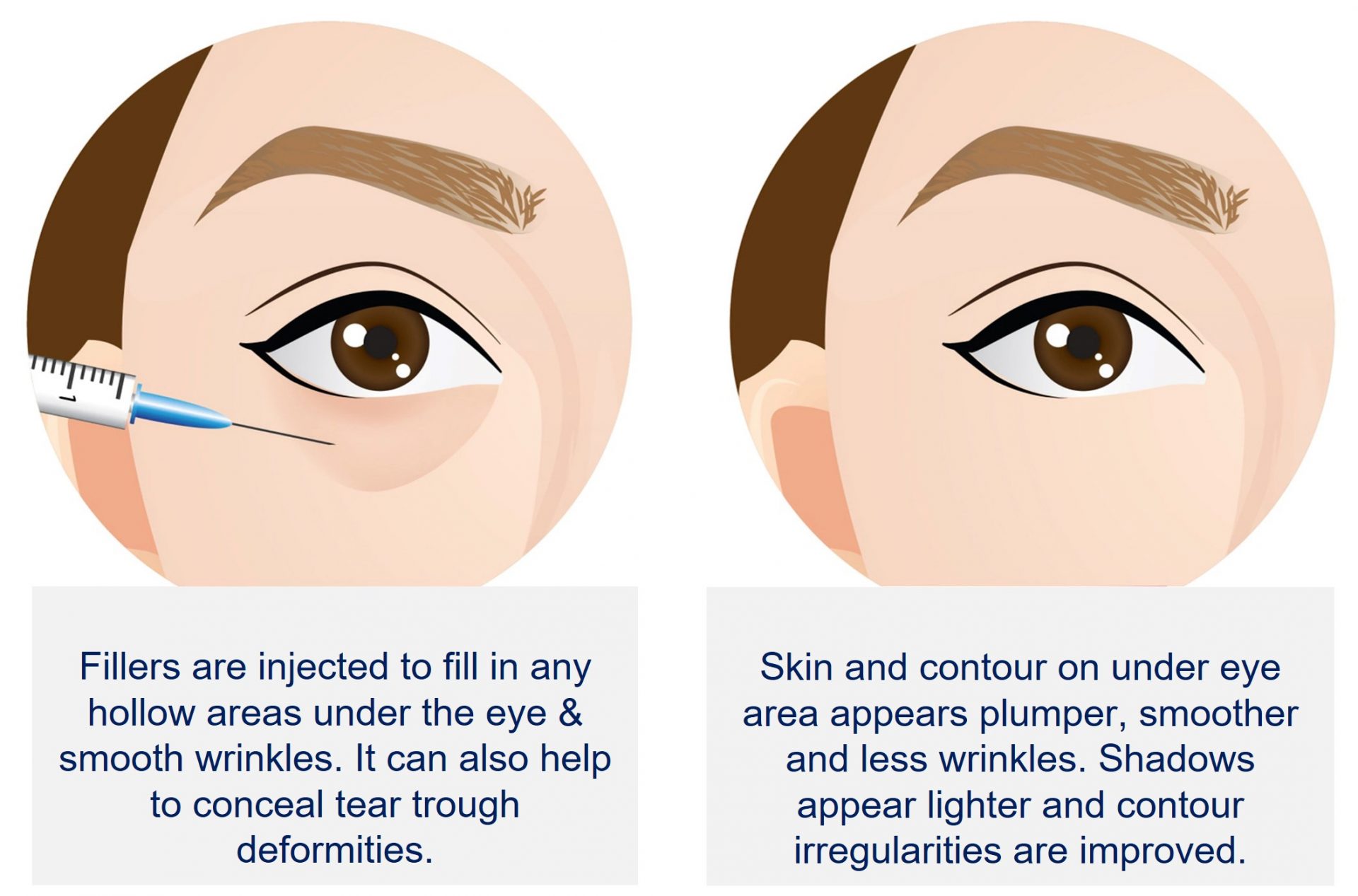 how fillers help to improve dark circles and eye bag