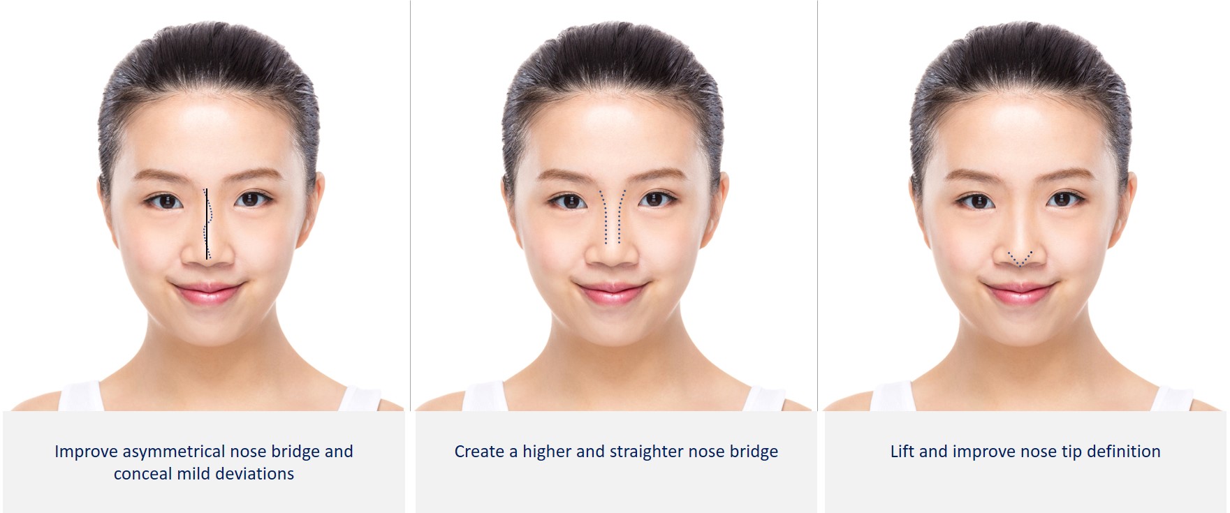 improvements from hiko nose thread lift - who is it suitable for