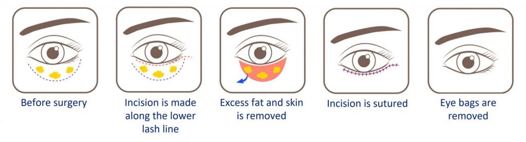 incisional eye bag removal surgery process