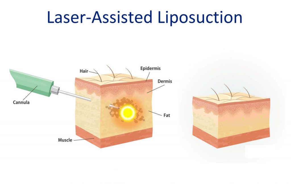 laser assisted liposuction method