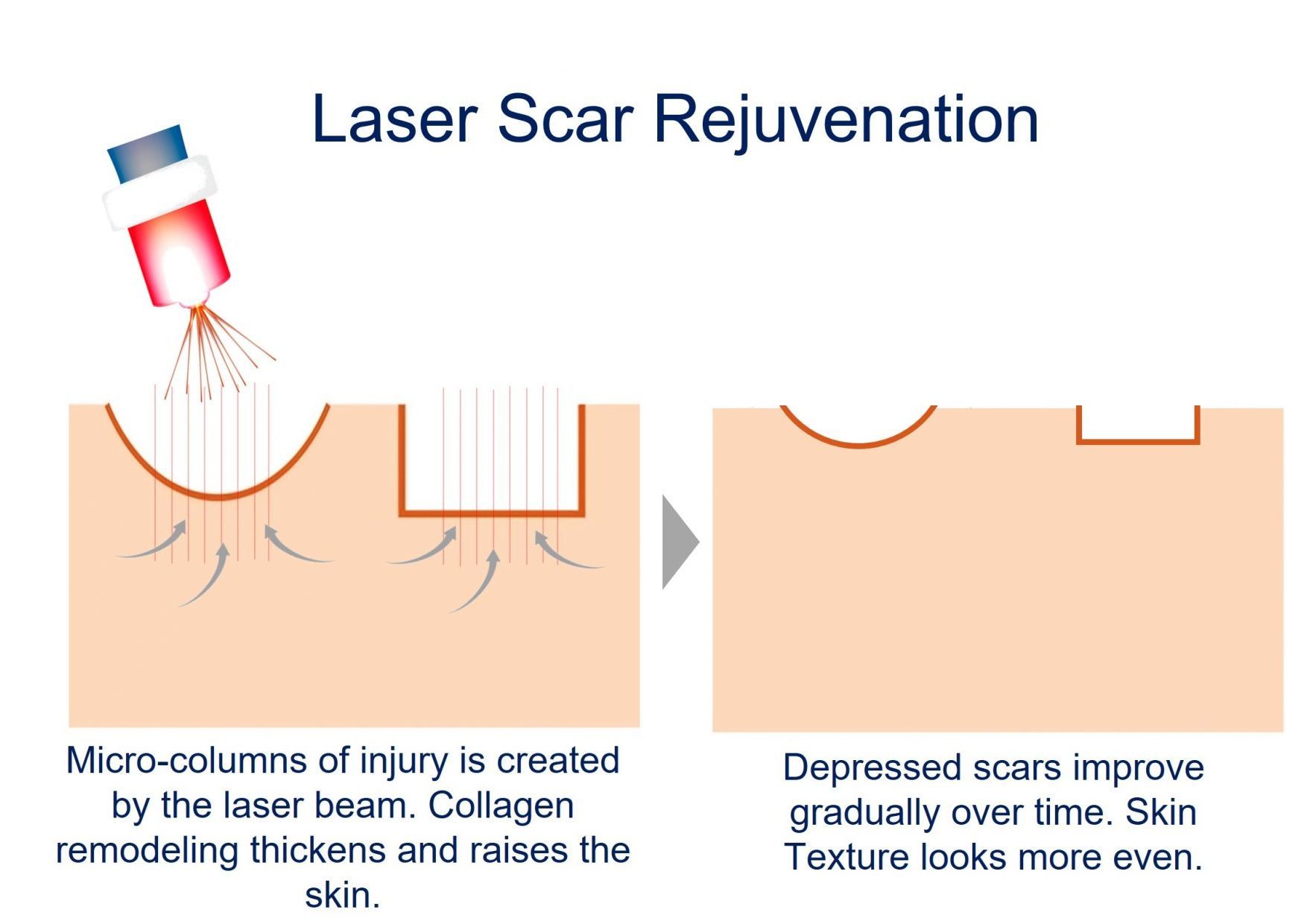 laser for rolling and box car scars