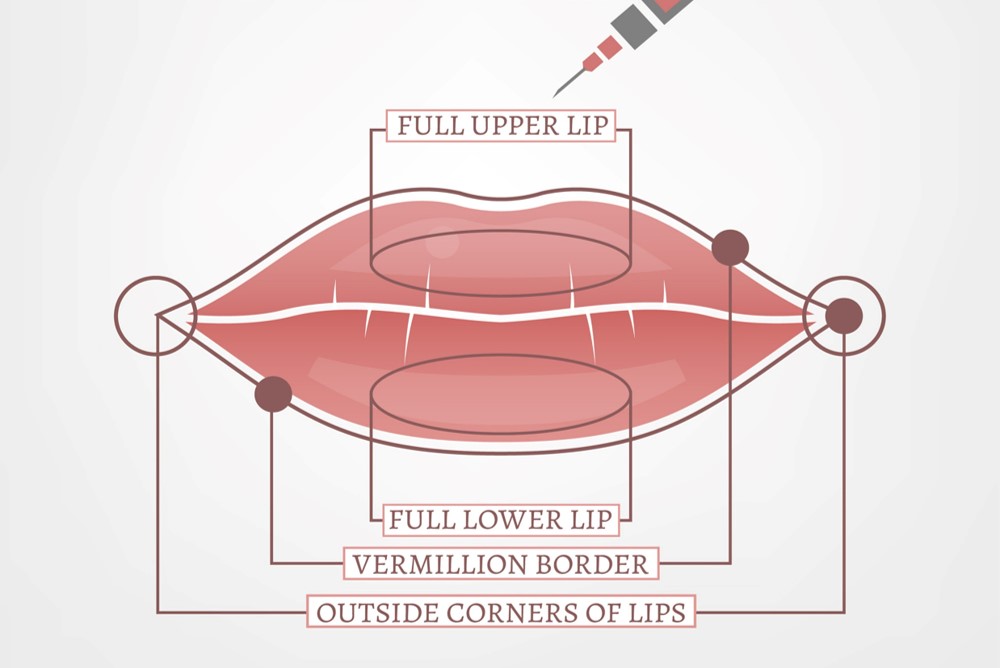 areas on the lip which can be injection with filler