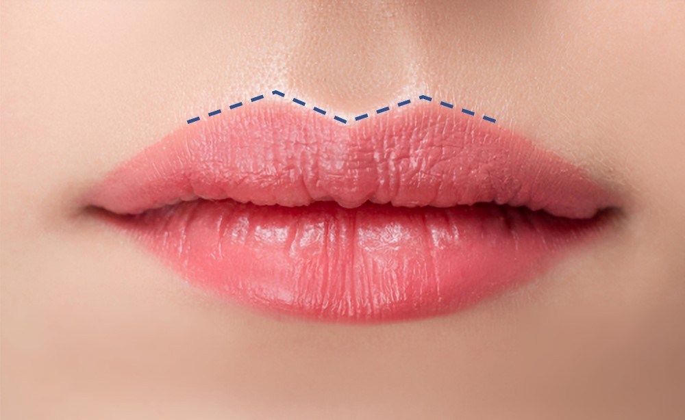 lip filler injection for defining cupids bow