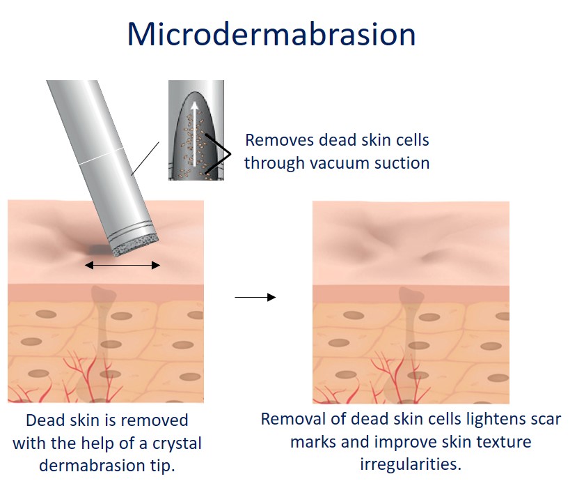 microdermabration for acne scar - how it works