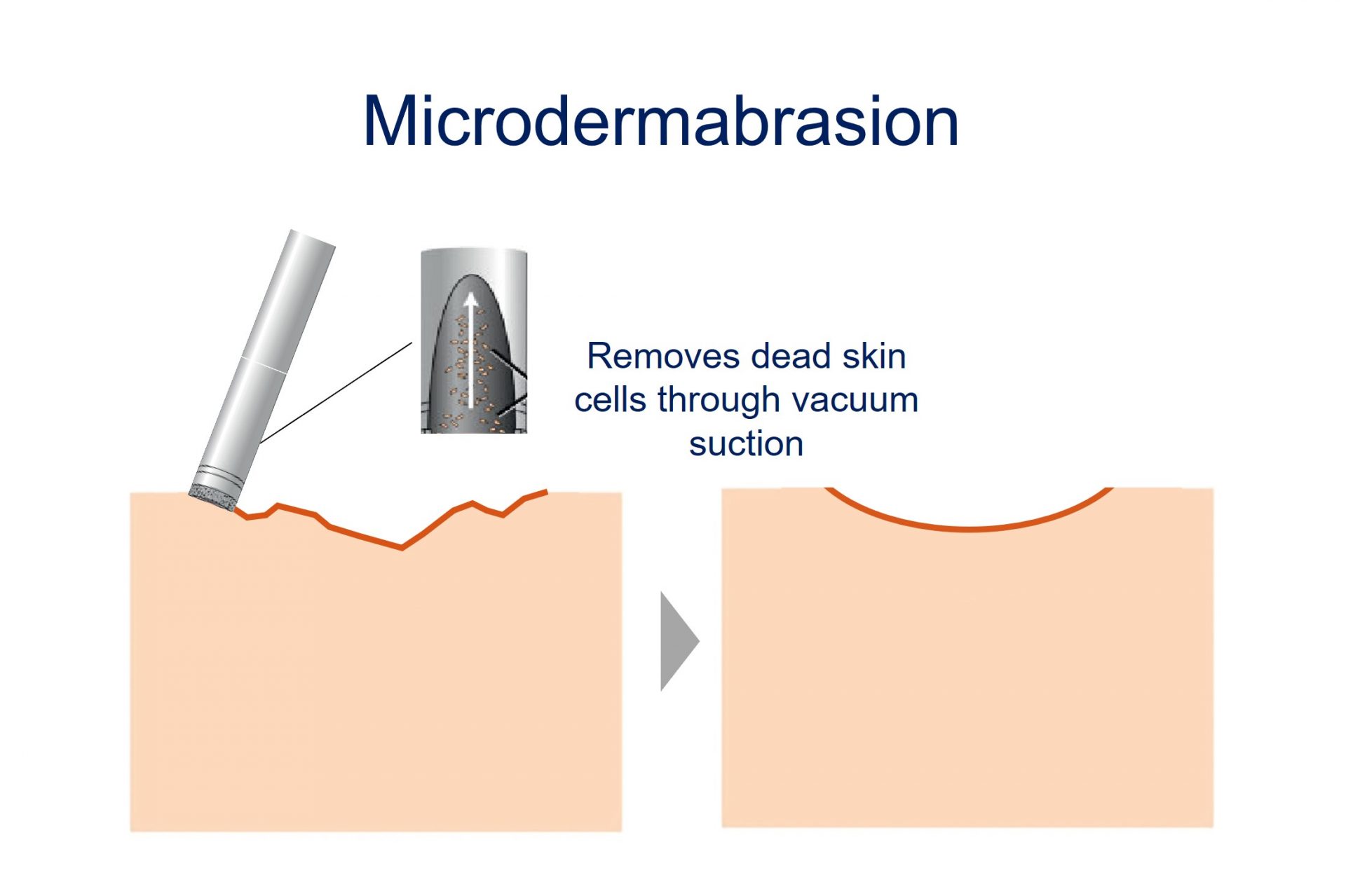 microdermabrasion for mild and gentle scars