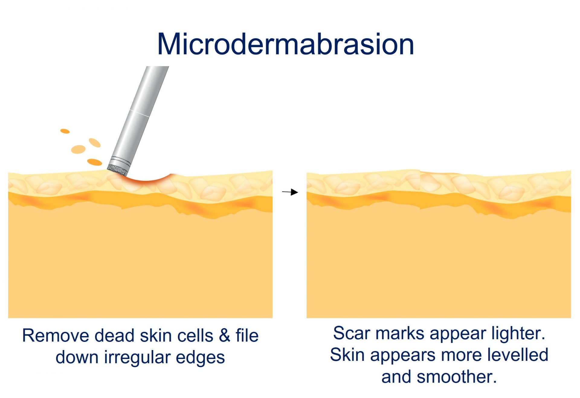 microdermabrasion - how it works
