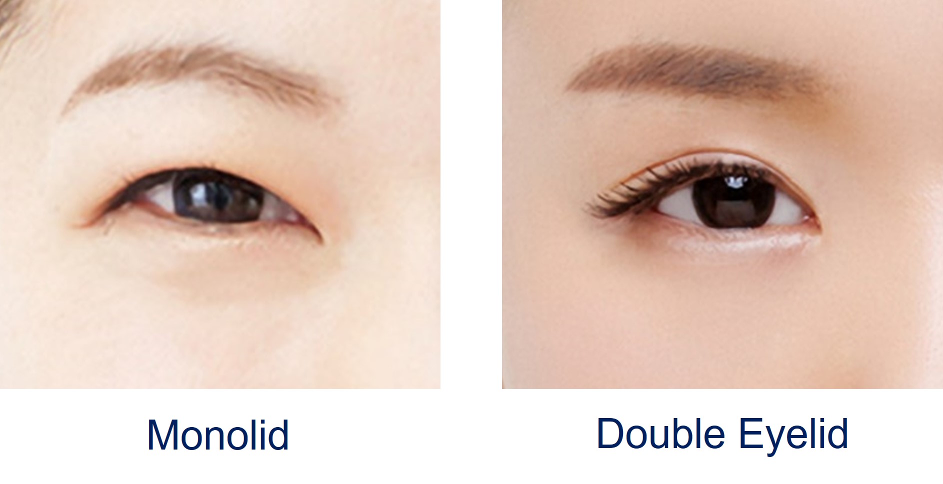 monolids versus double eyelid