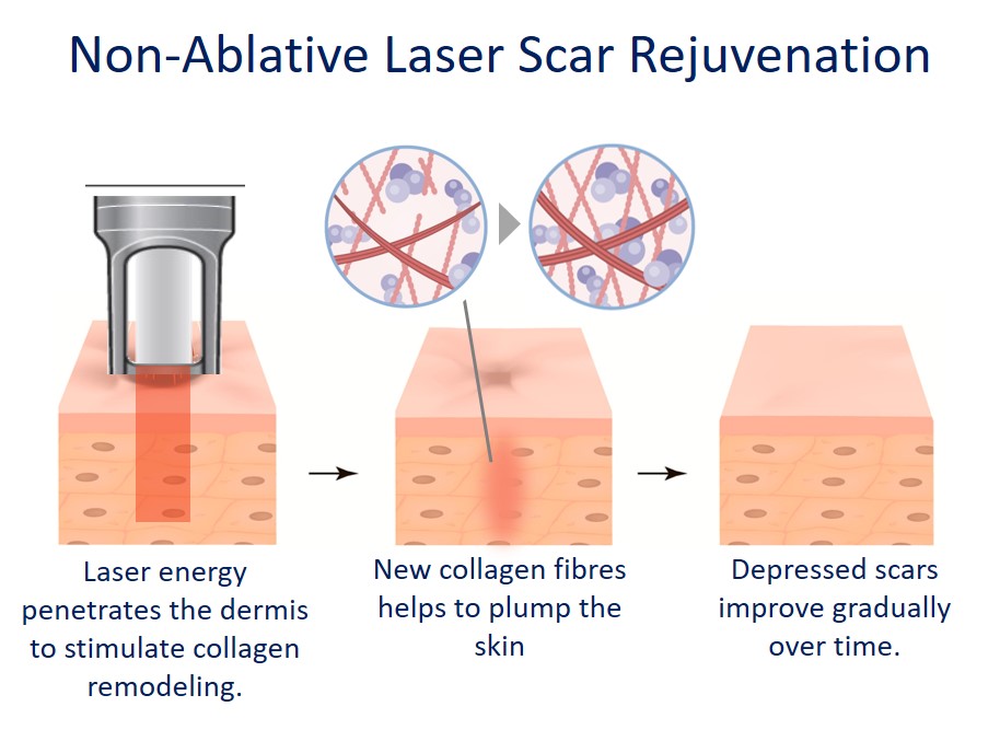 non-ablative laser for acne scar lightening - how it works