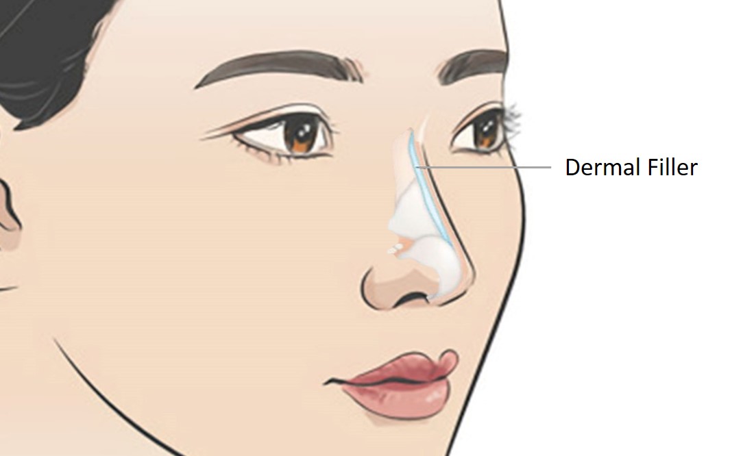 placement of nose fillers