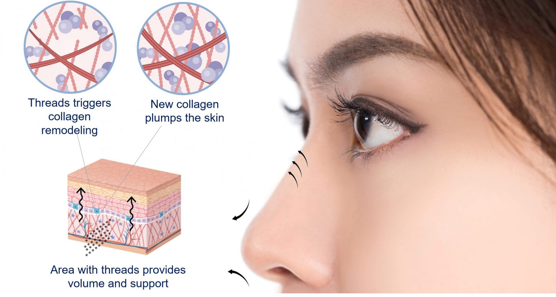 nose thread lift - mechanical lift