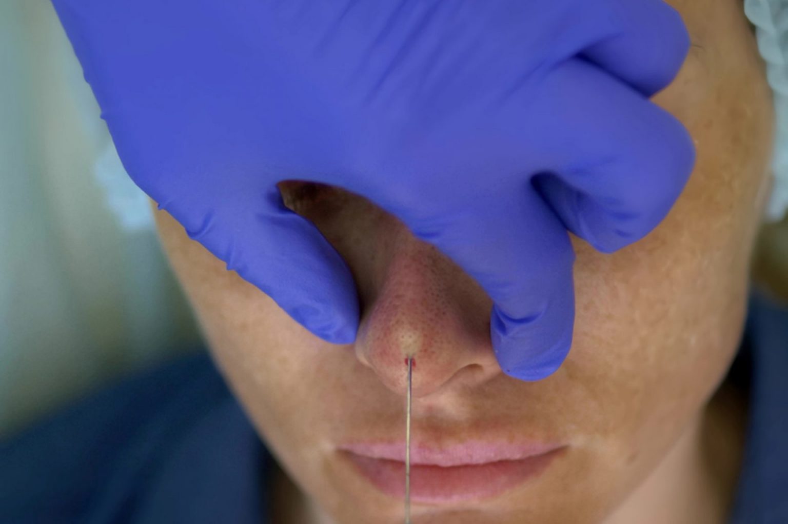 What Should You Avoid After A Nose Thread Lift? | Dream Plastic Surgery