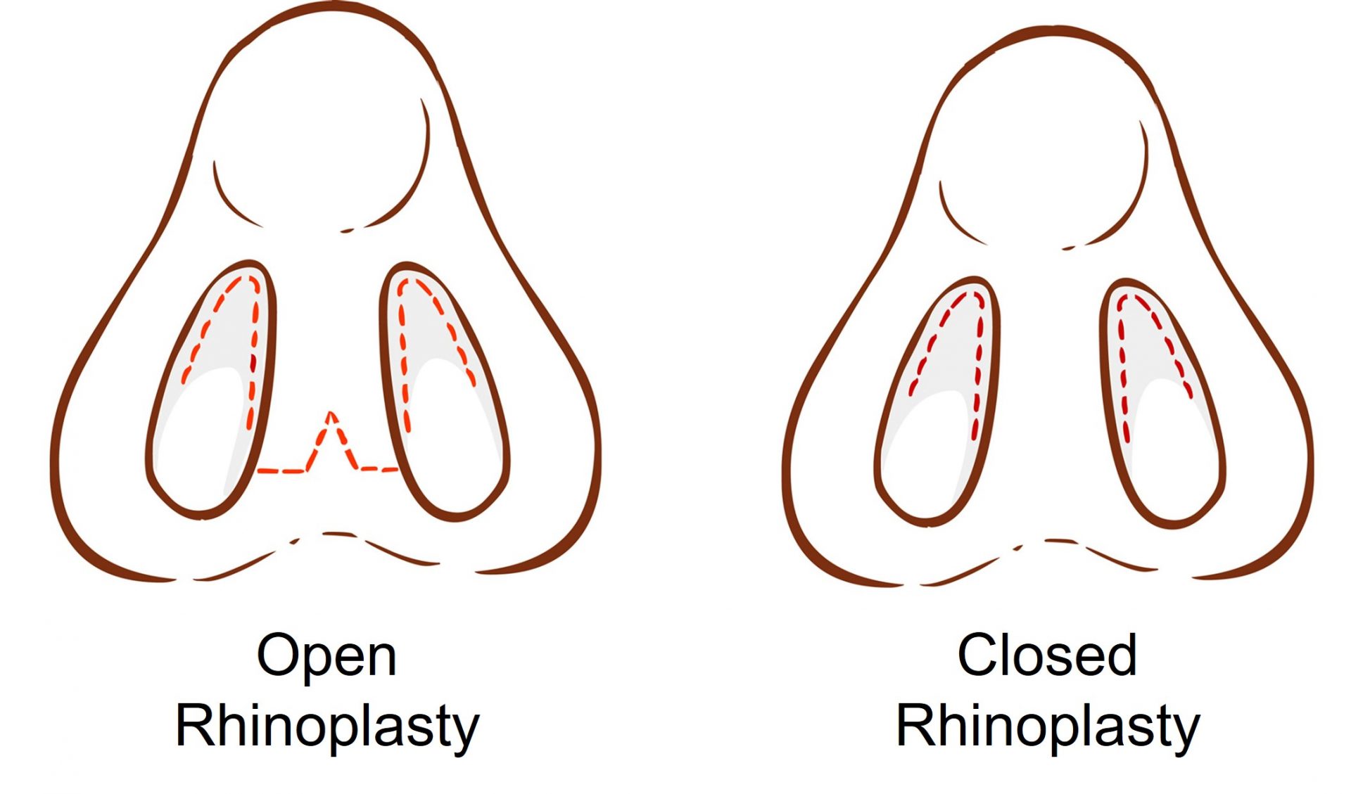 open and close rhinoplasty incisions