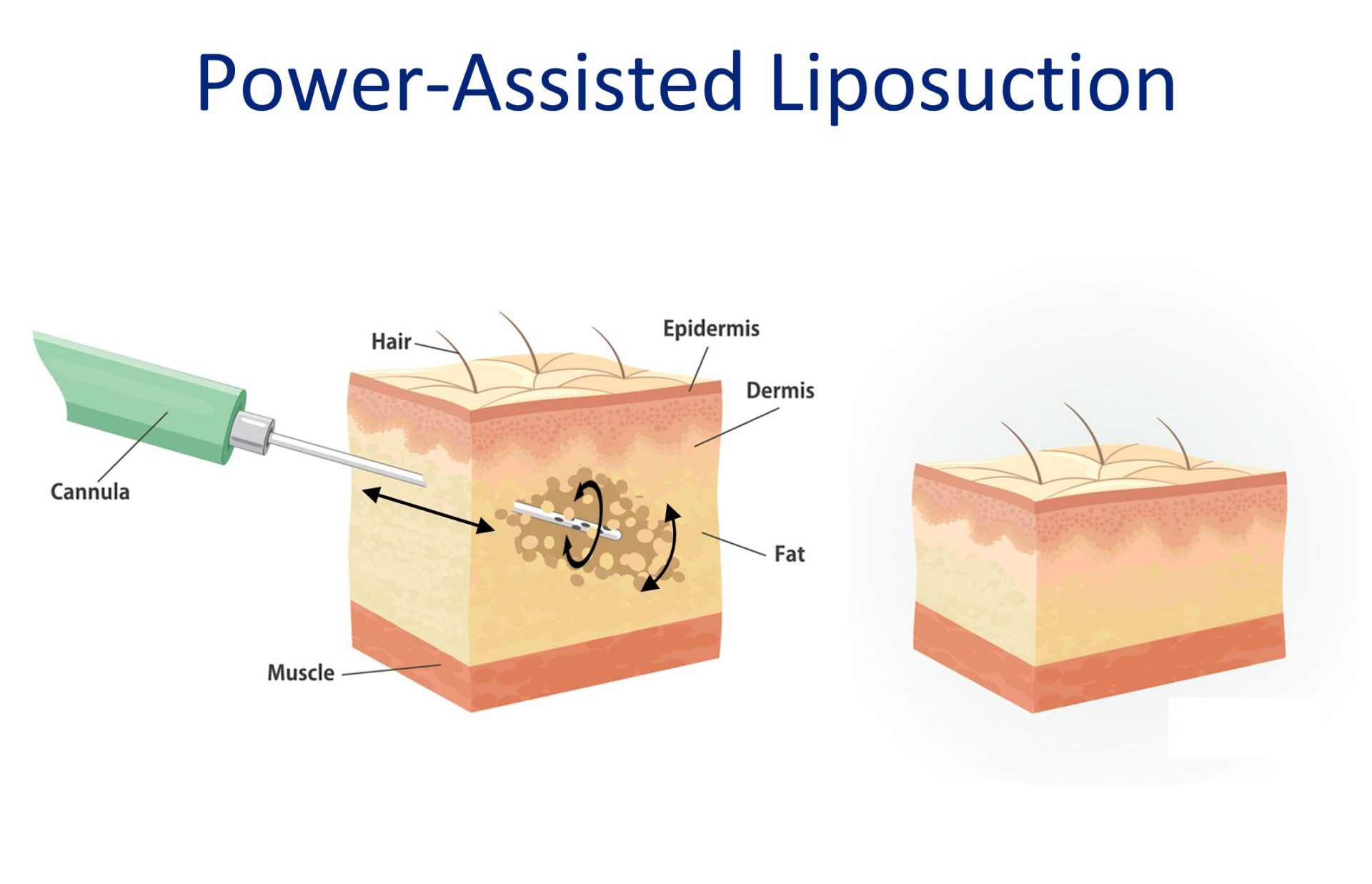 power assisted liposuction method