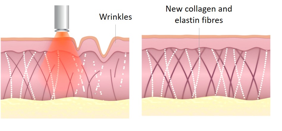 rf skin tightening - how it works