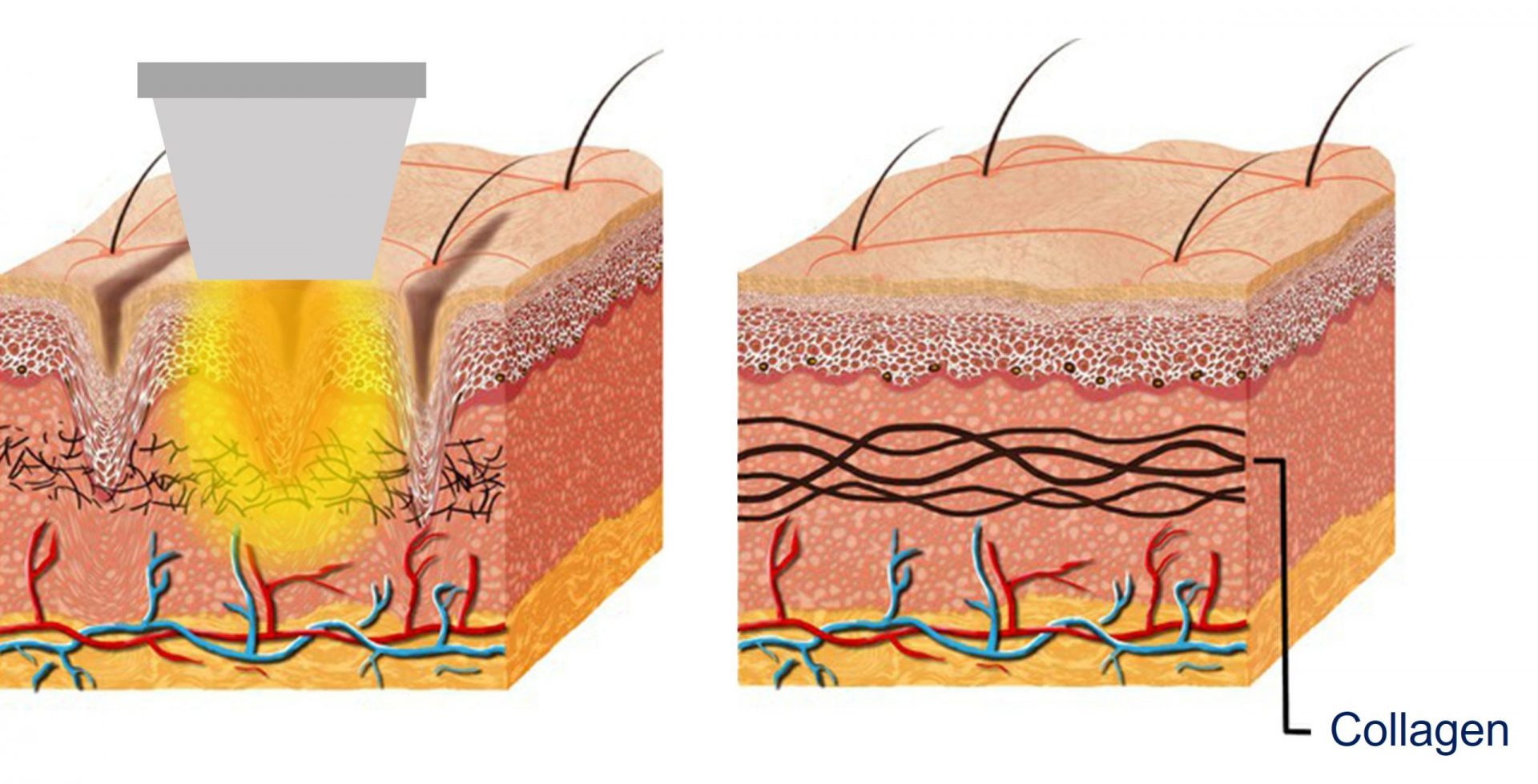 radio frequency skin tightening mechanism