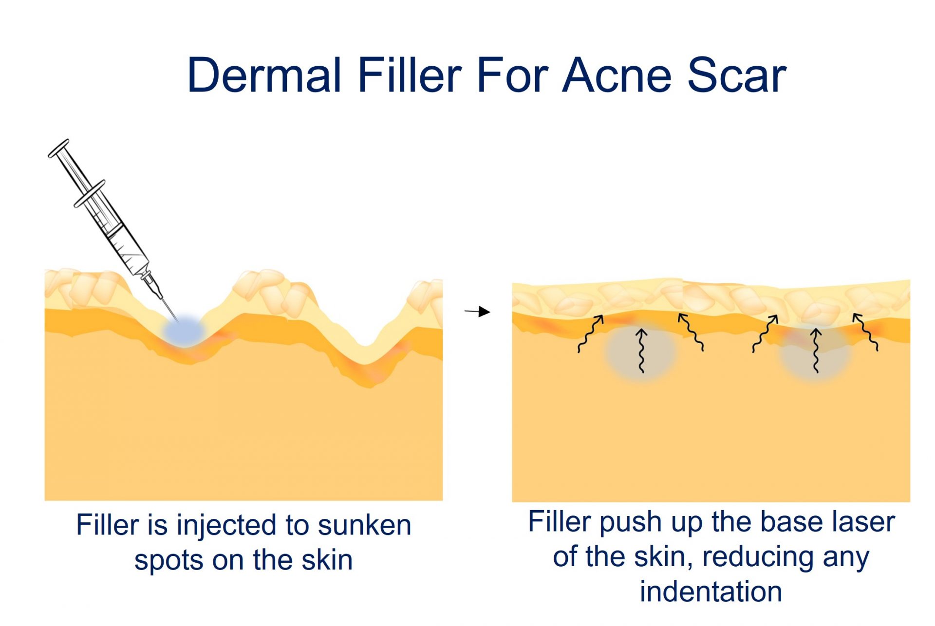 dermal fillers for acne scar - how it works