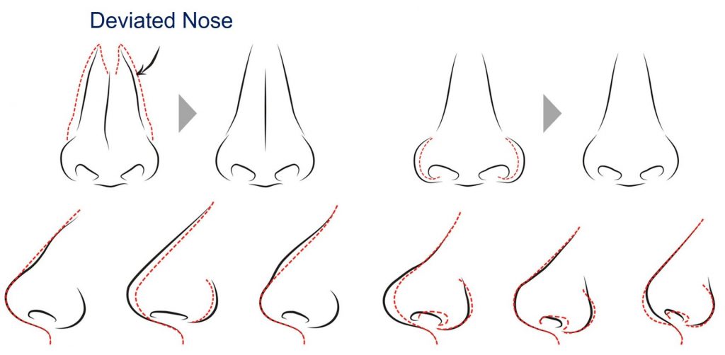 improvements from rhinoplasty surgery - nose job