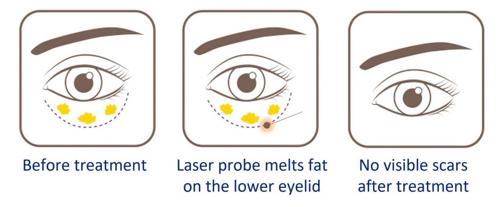 scarless eye bag removal treatment process