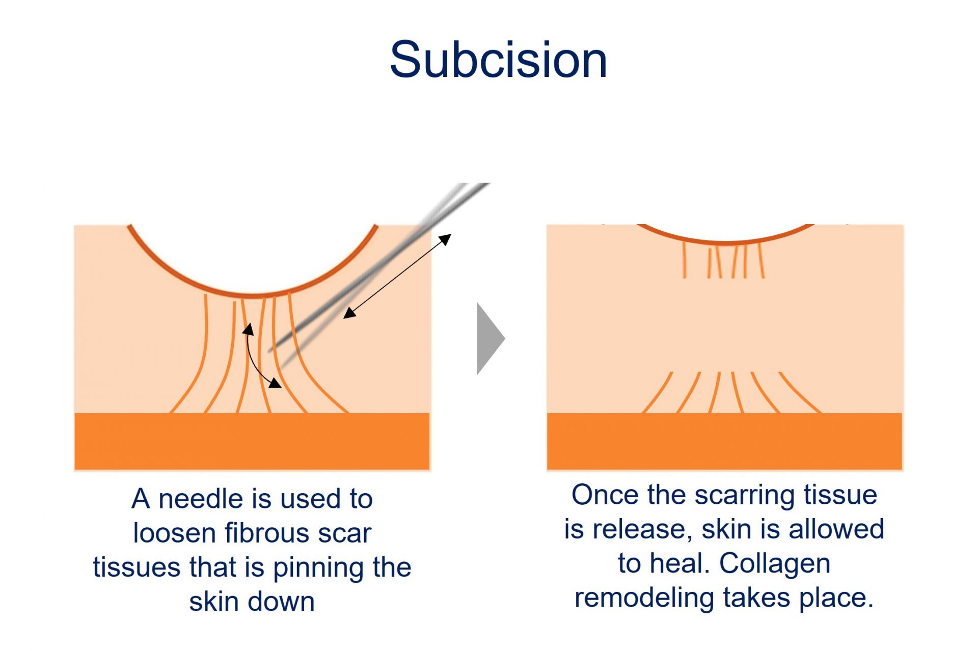 subcision for depressed acne scars