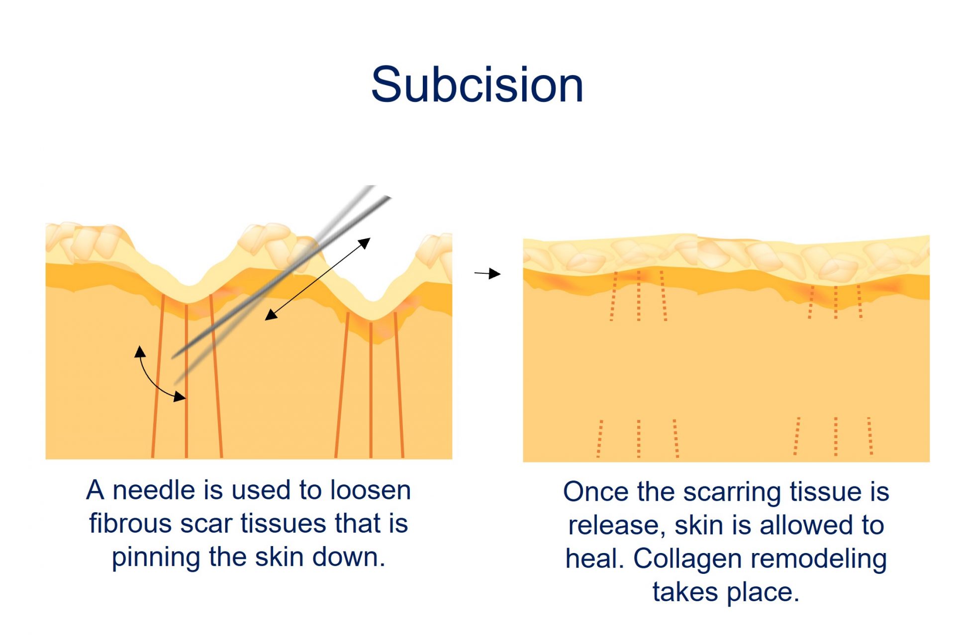 acne scar subcision - how it works
