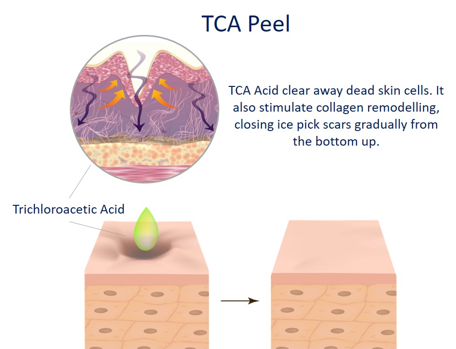 tca peel for acne scar lightening - how it works