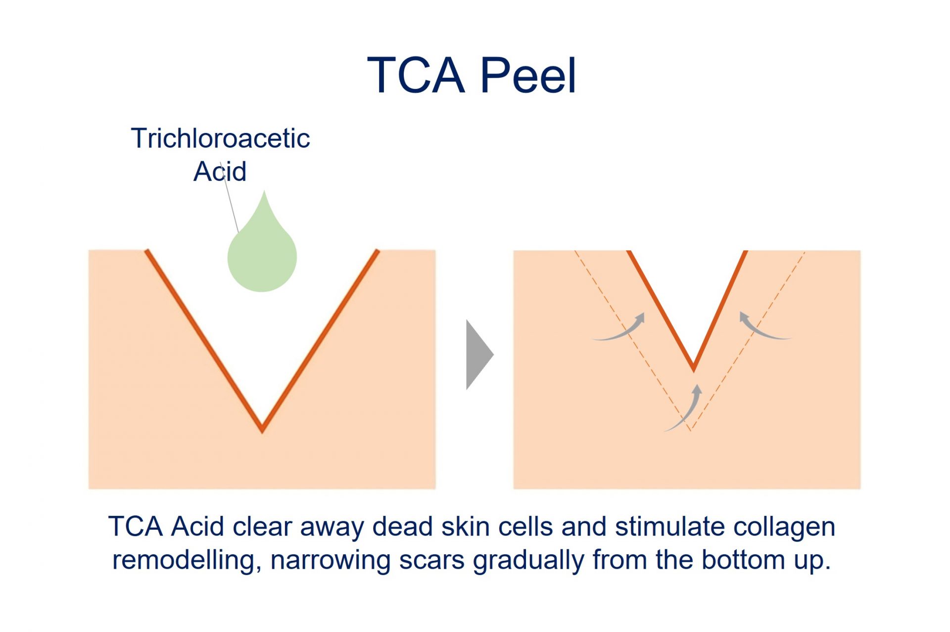 tca peel treatment for ice pick scars