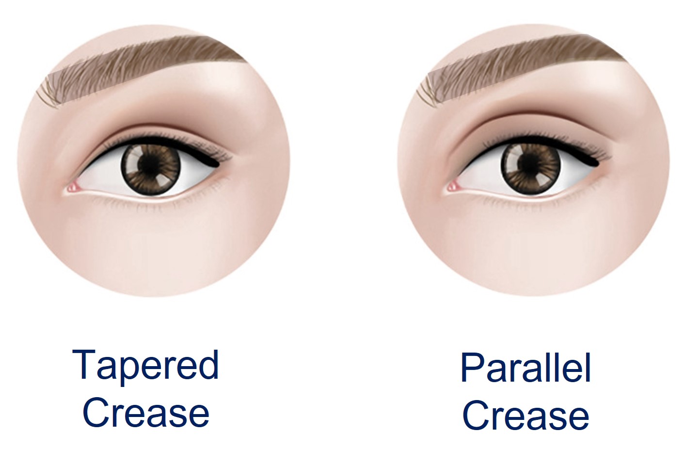 tapered versus parallel eyelid crease