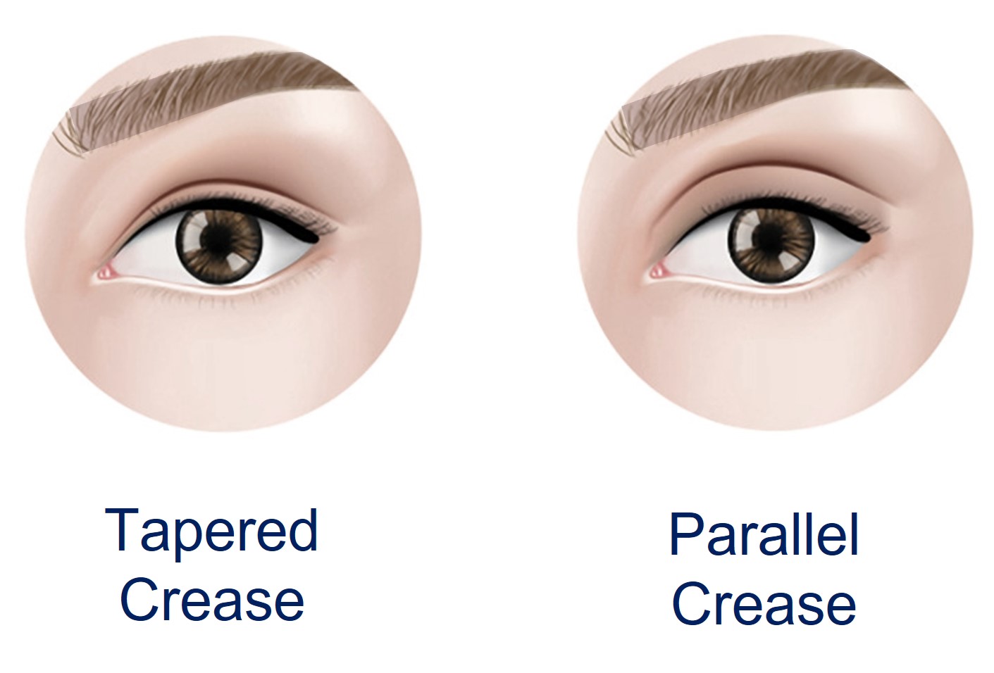 Parallel double hot sale eyelid