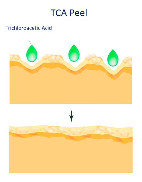 tca peel - how does it work