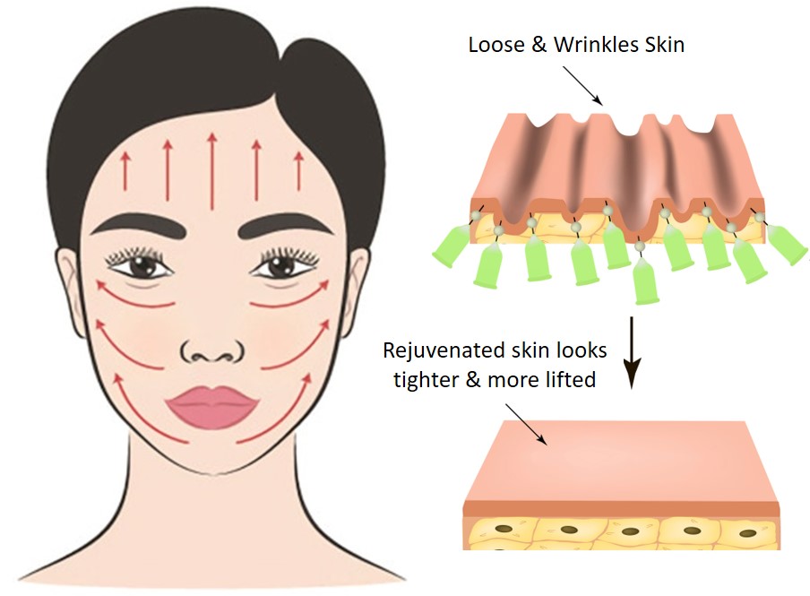 thread lift for skin tightening and lifting mechanism
