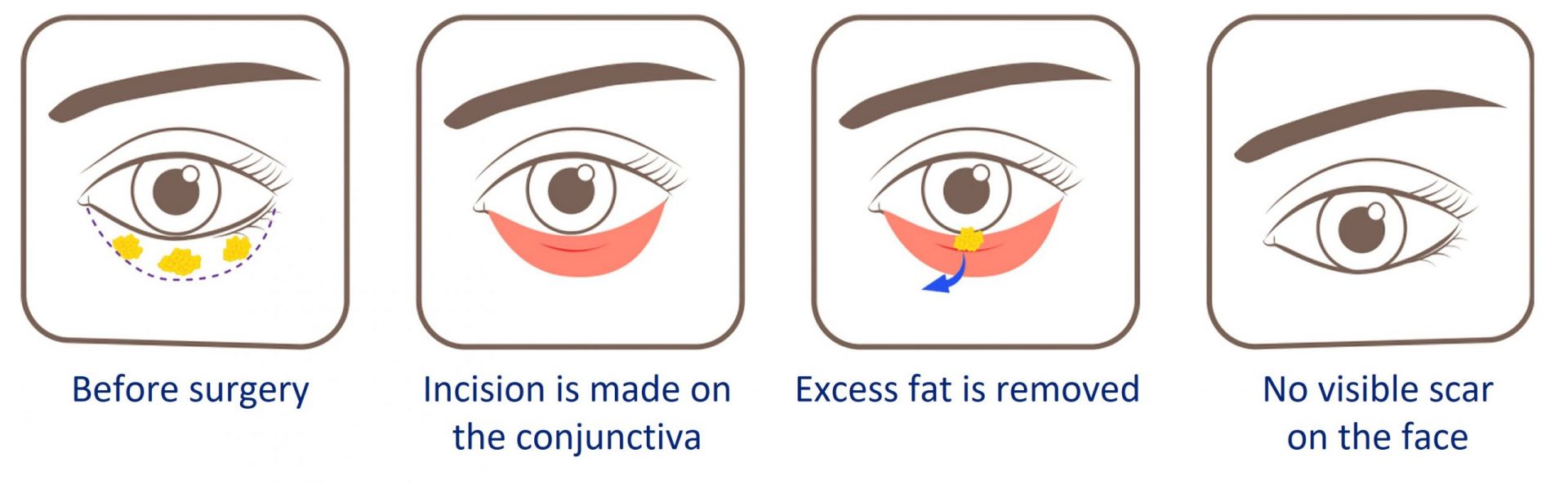 transconjunctival method eyebag surgery