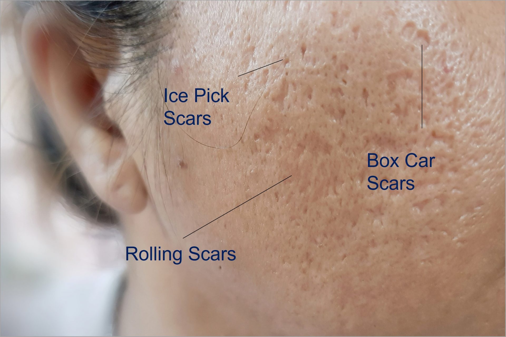 identifying different types of acne scars