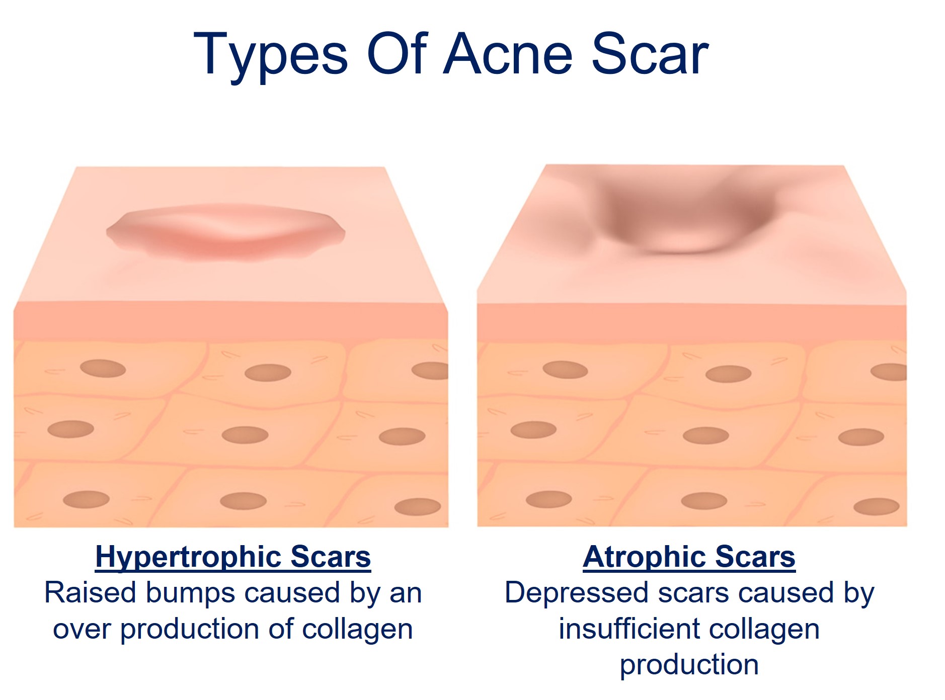 types of acne scaring