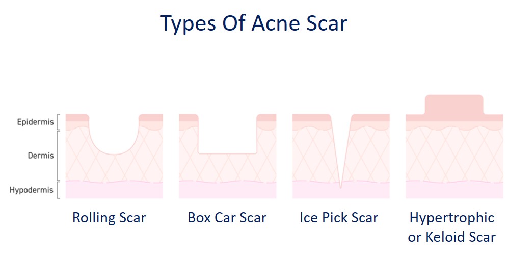types of acne scar