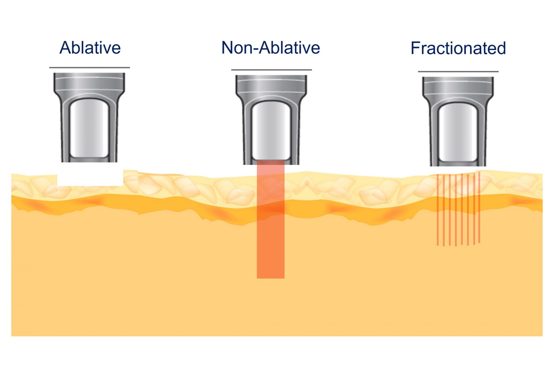 types of lasers for acne scar treatment