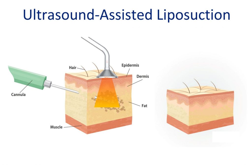 ultrasound assisted liposuction