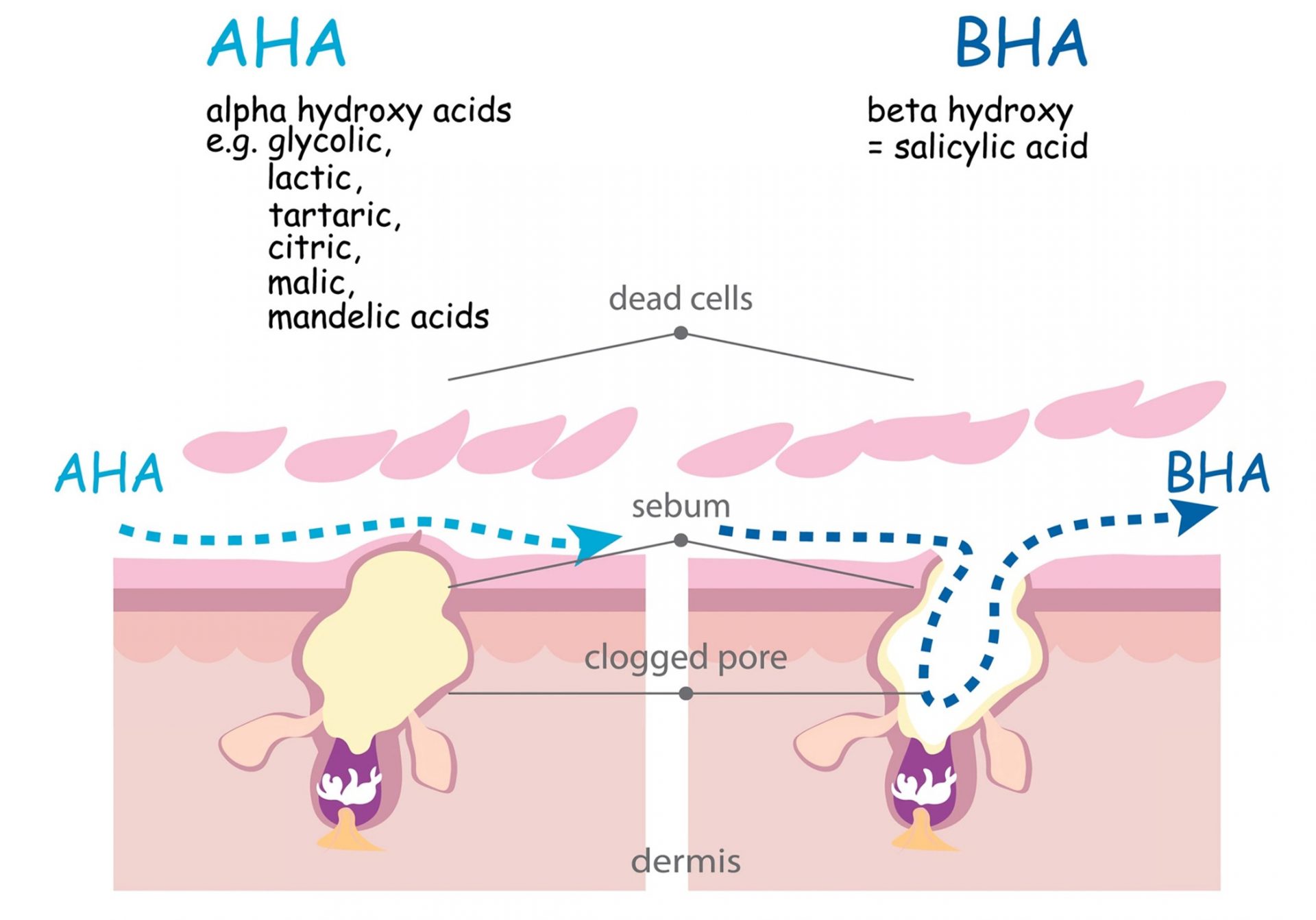 aha and bha acid for improving acne skin