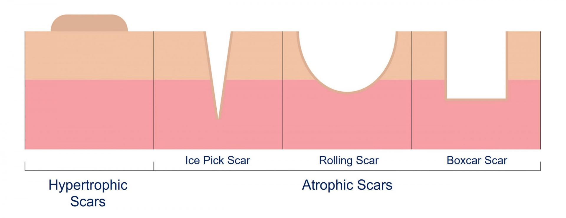 types of acne scar