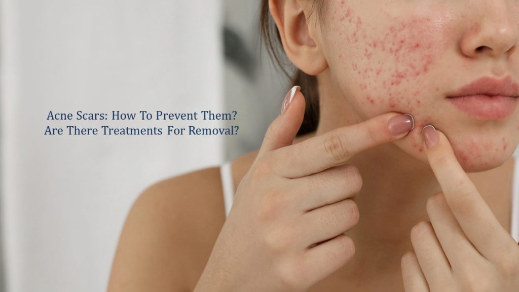 acne scars - how to prevent them - are there treatments for removal