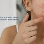 acne scars - how to prevent them - are there treatments for removal