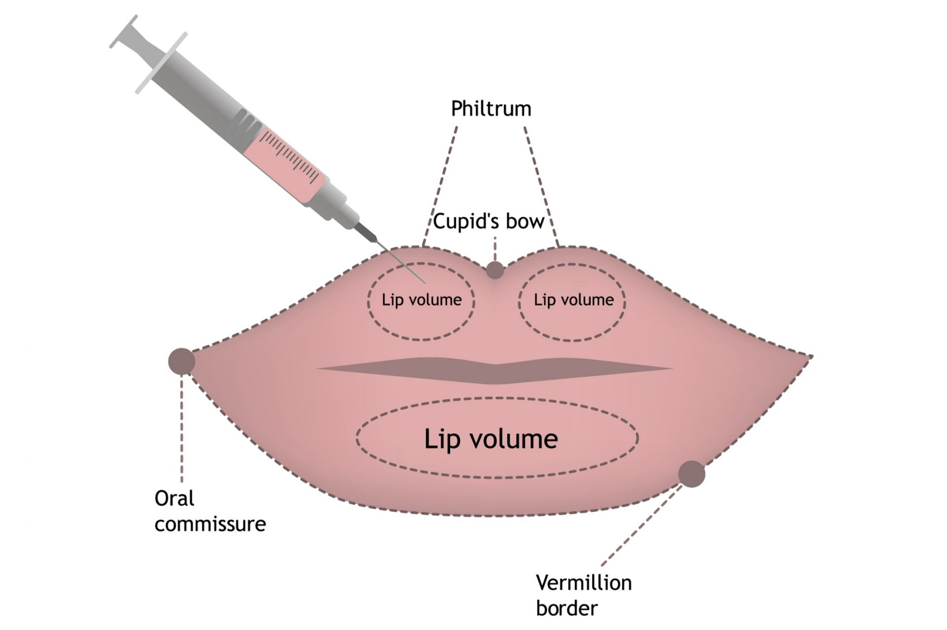 areas suitable for lip filler injection