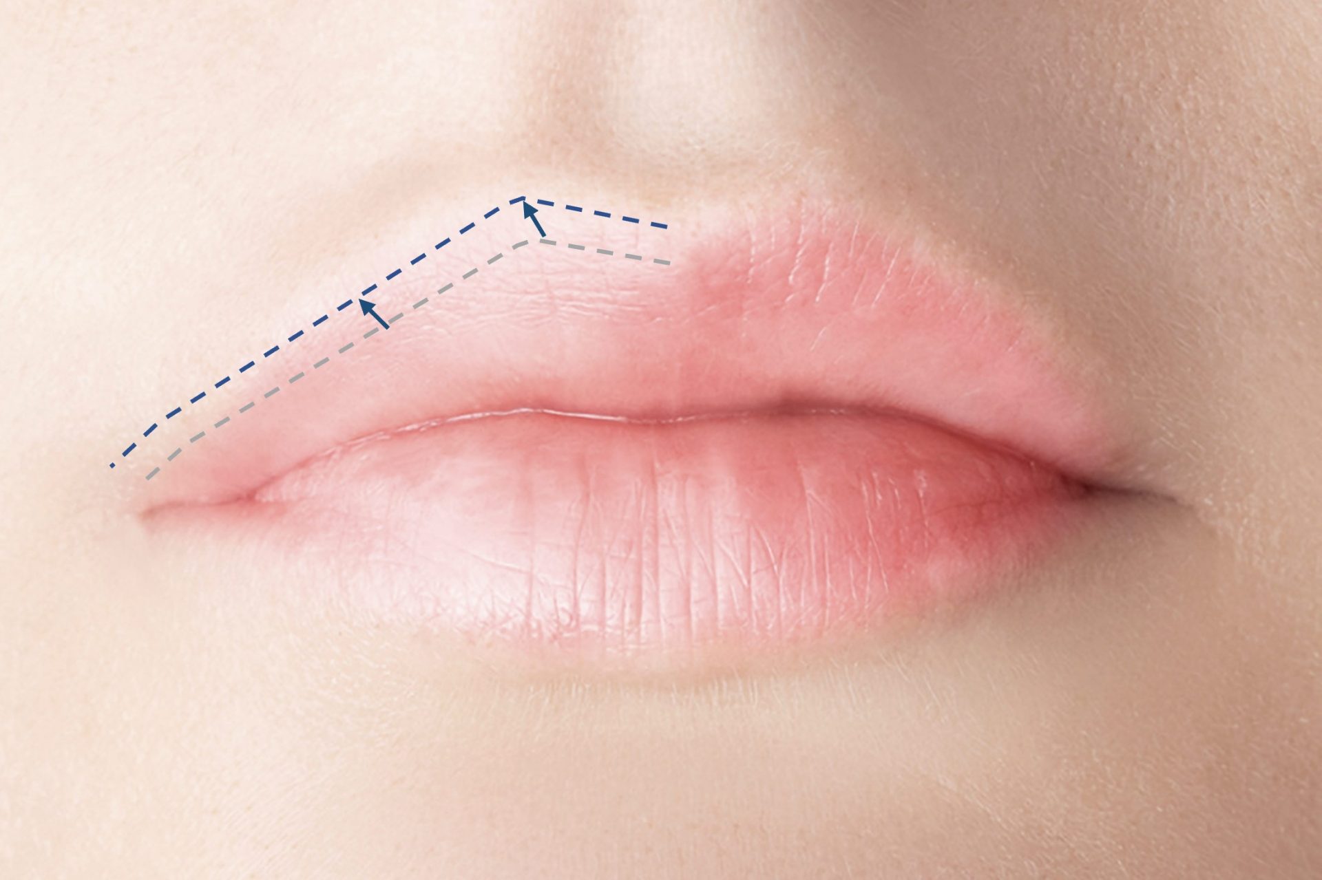 improve lip asymmetry