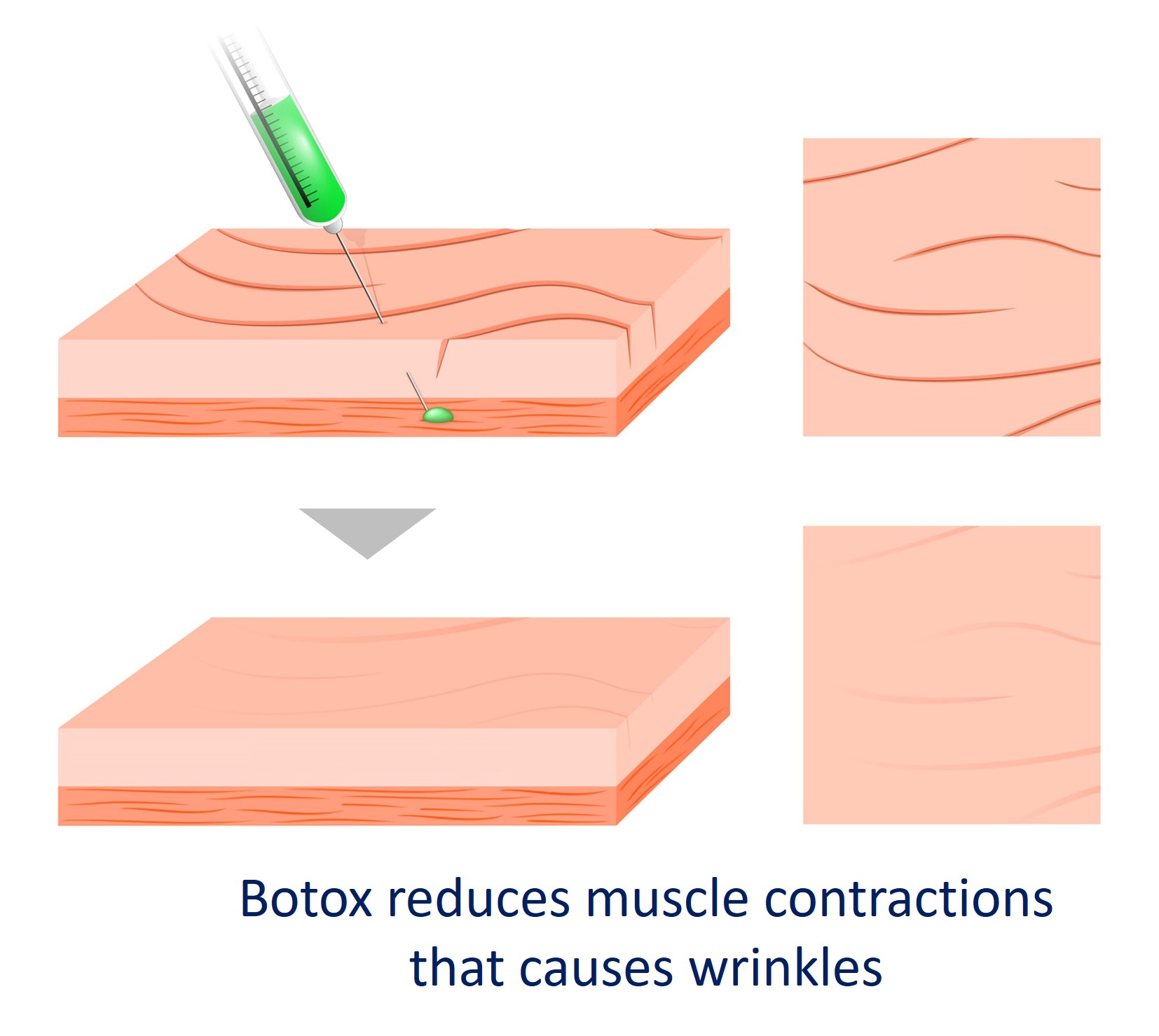 effects of botox injection singapore