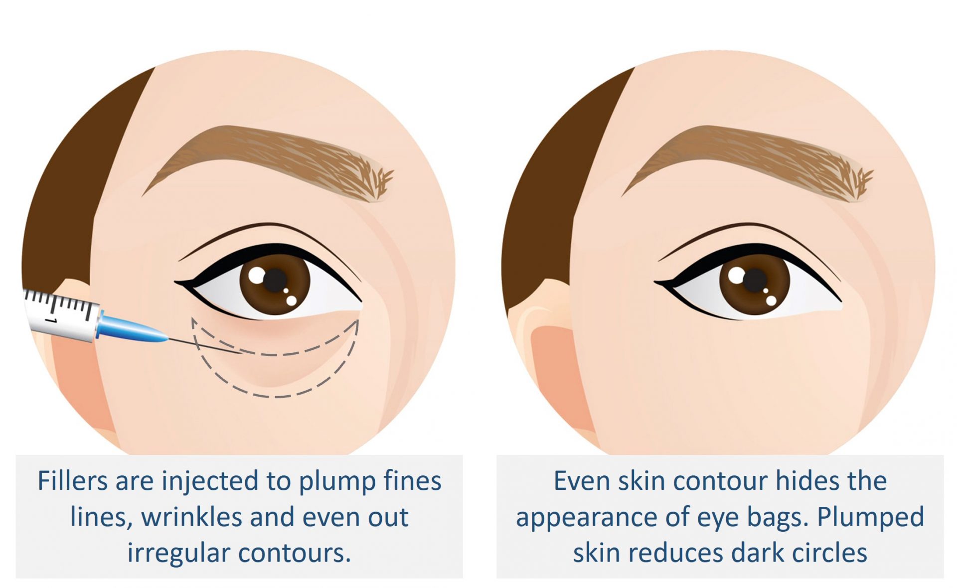 fillers under eyes before and after image representation
